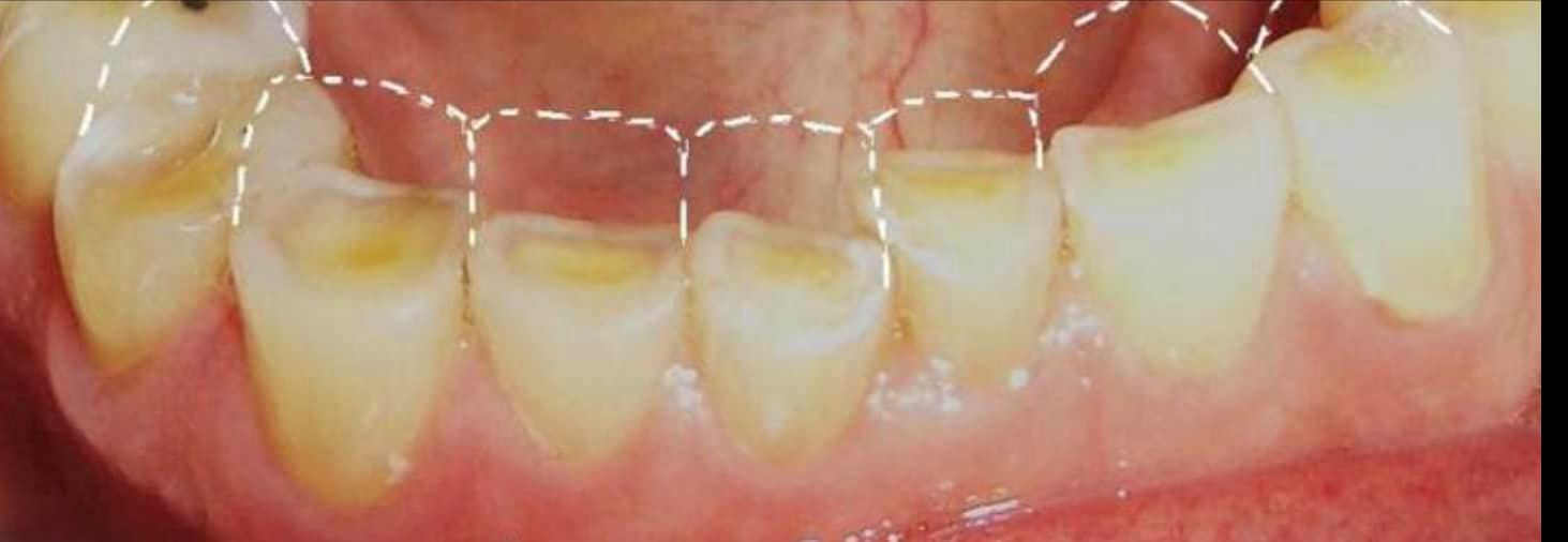 Tooth surface loss (TSL) or tooth wear (TW) Dr. Ljubica Banić