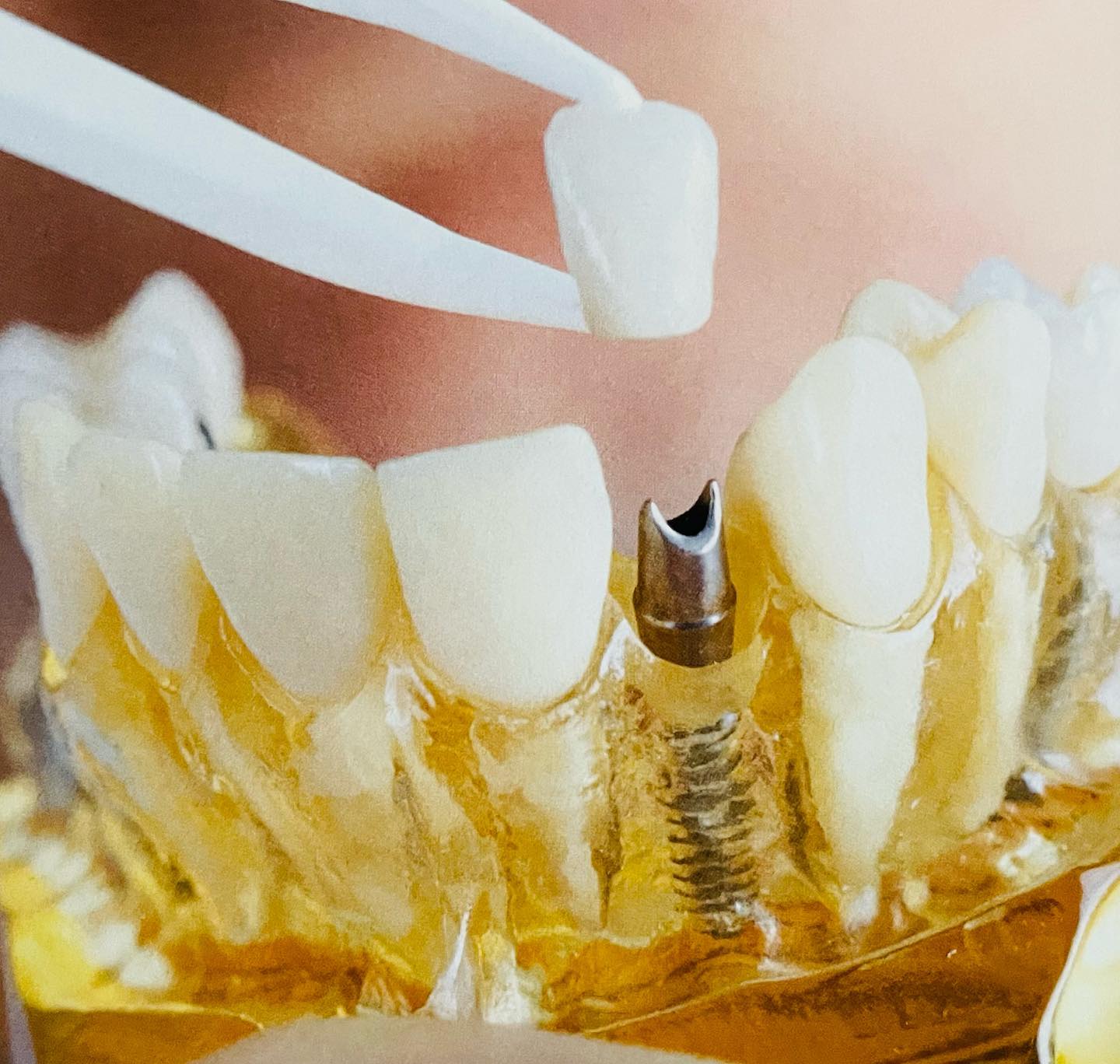 How long do teeth implants last? – Dr. Ljubica Banić